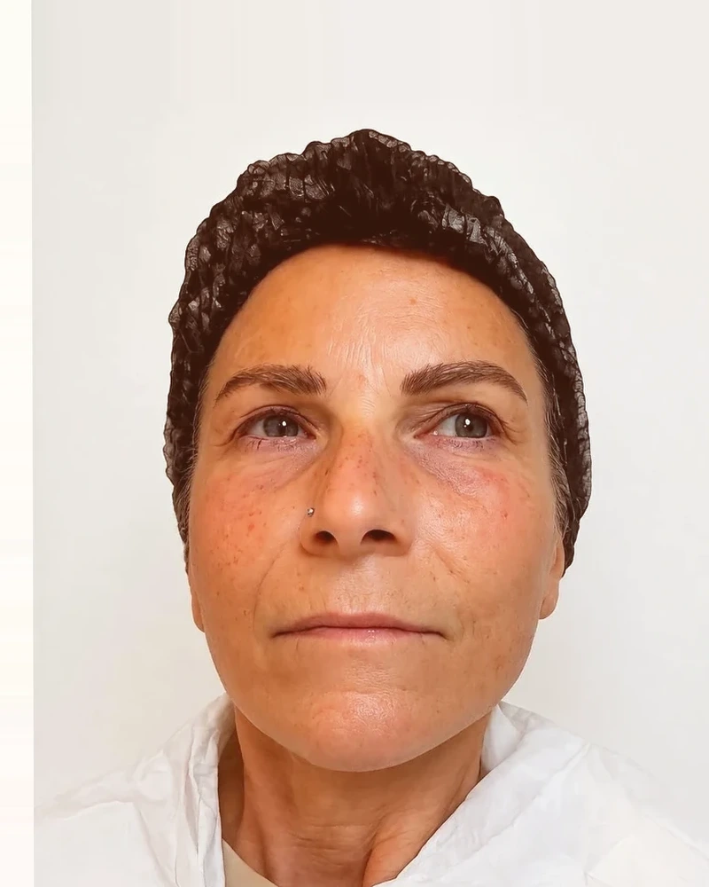 Client after Kelly Davies Ultimate Facelift PDO COG thread treatment