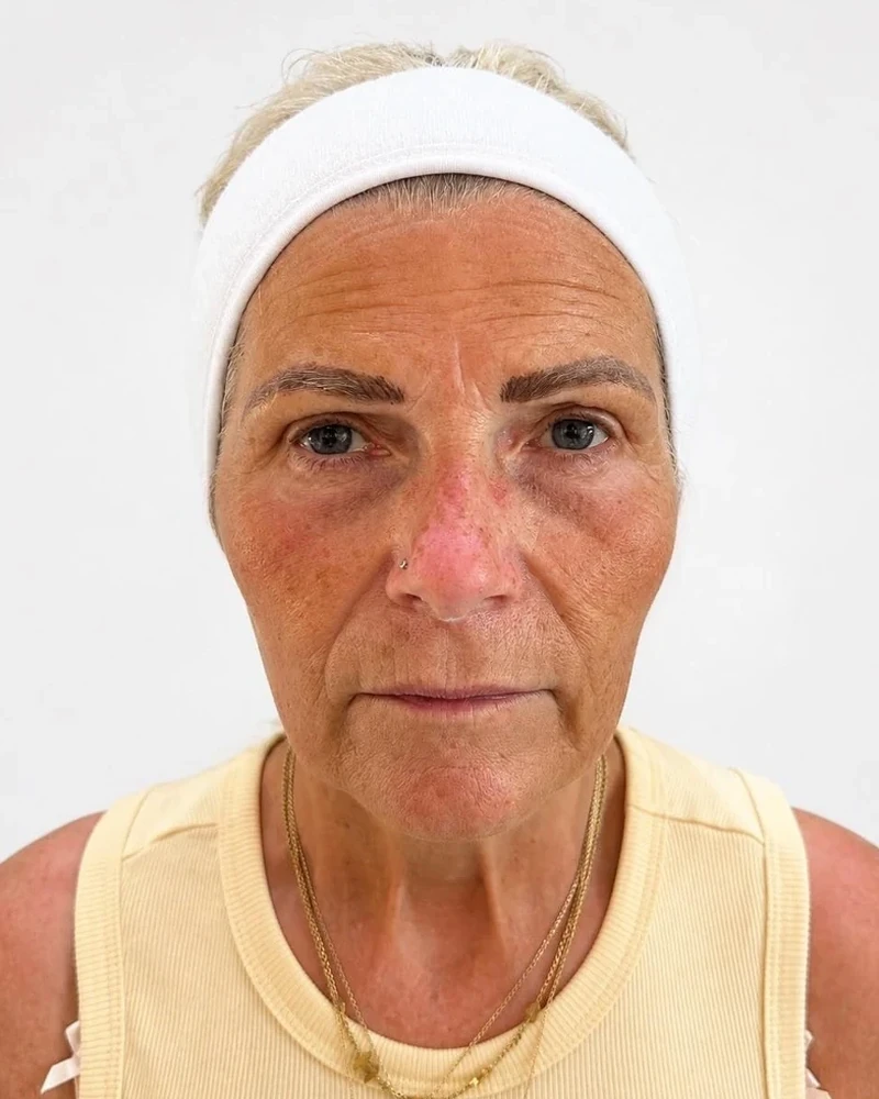 Client before Kelly Davies Ultimate Facelift PDO COG thread treatment